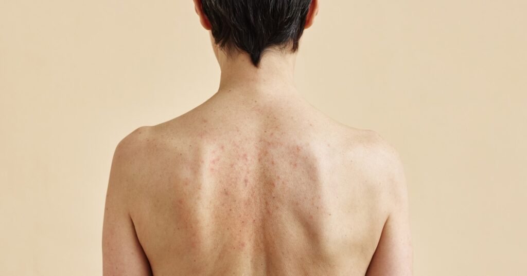 Effective strategies for eliminating back acne per dermatologists