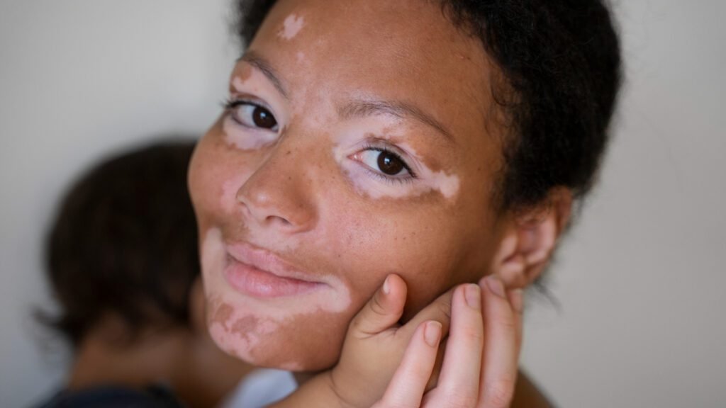 Understanding vitiligo: insights from dermatologists on this skin condition