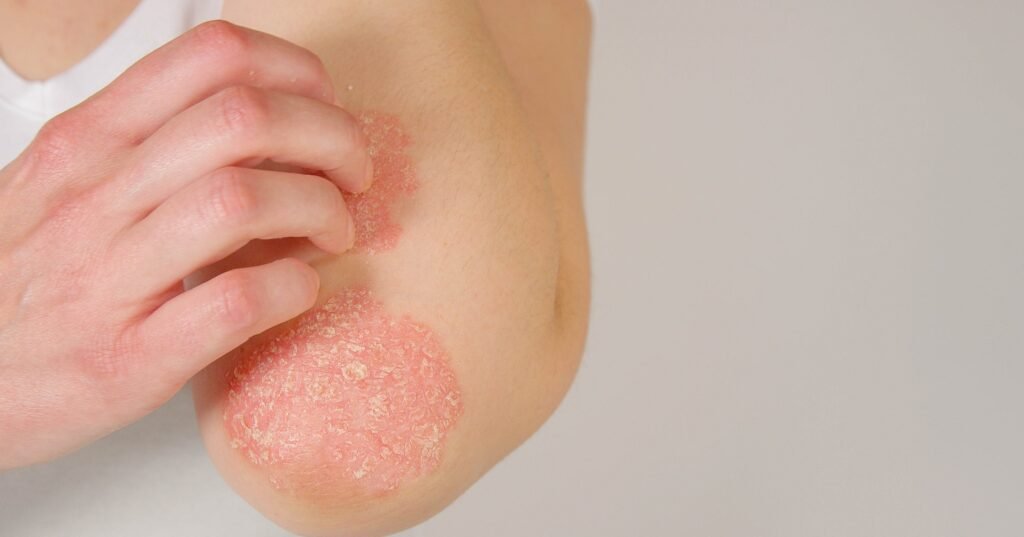 Psoriasis uncovered: expert insights on symptoms and solutions
