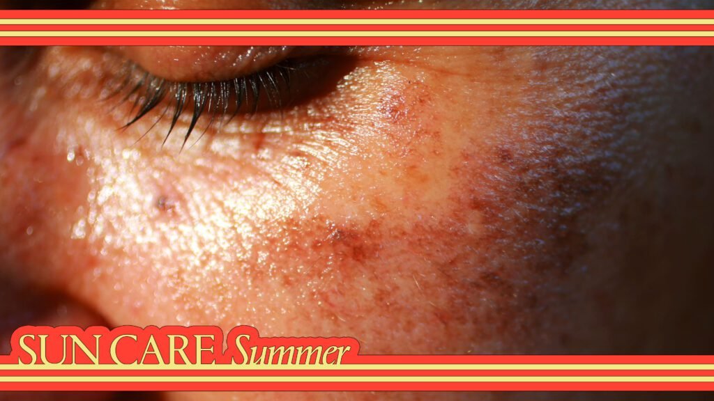 Top dermatologist recommended treatments for melasma