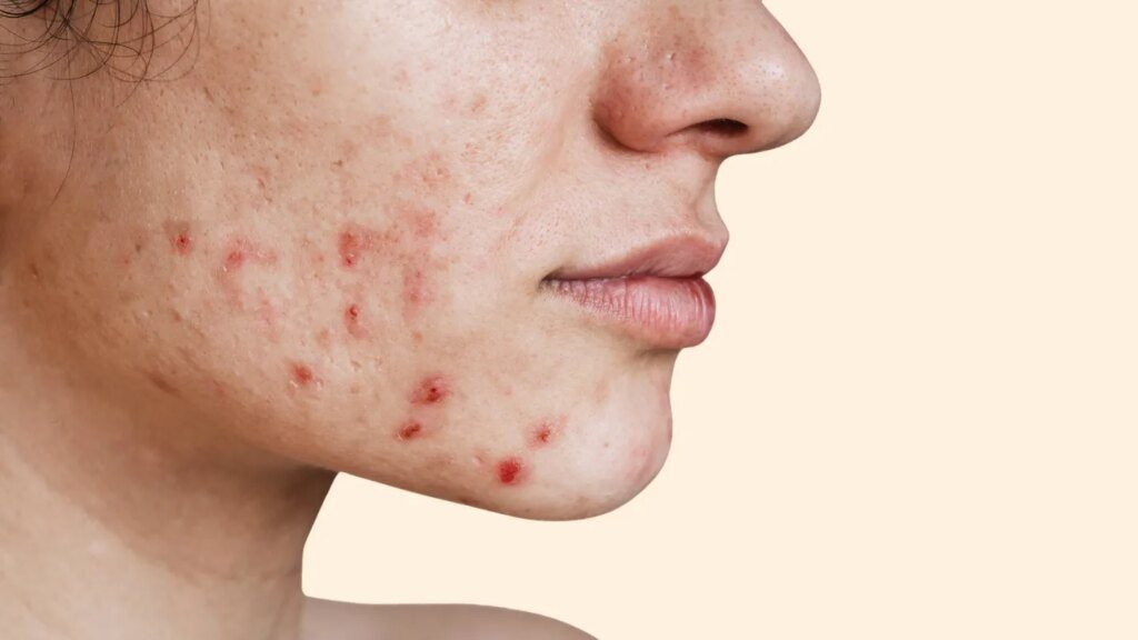 Unlocking the secrets of acne: what your breakouts reveal