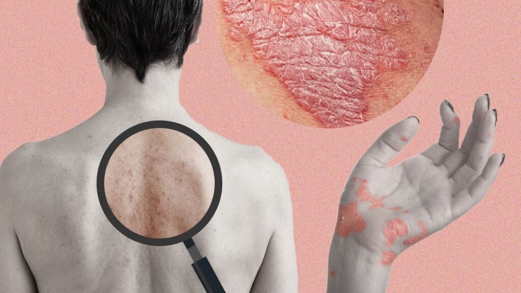When to seek dermatological help for eczema and psoriasis