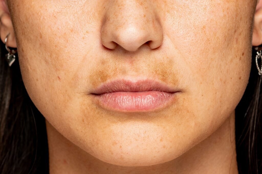 Women with skin conditions face higher rates of body dysmorphic