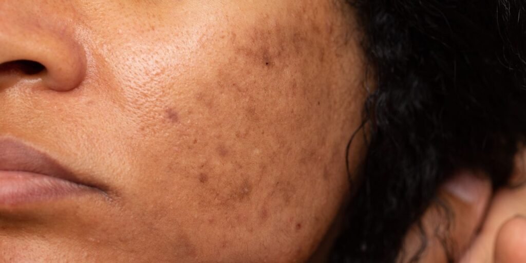 6 skin care habits that worsen dark spots