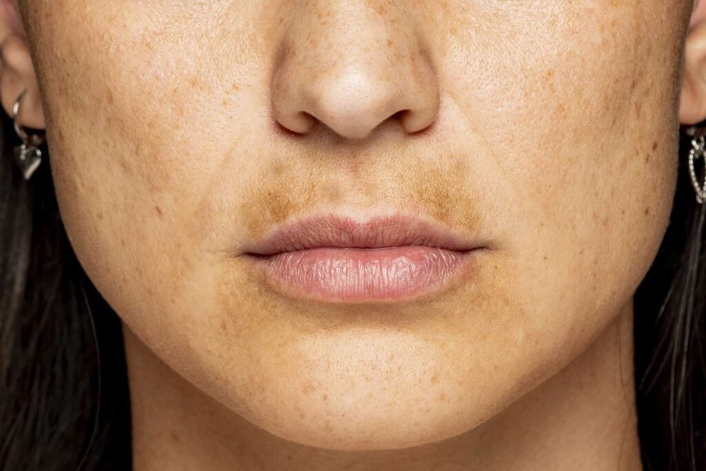 Banishing the melasma mustache: effective solutions and tips