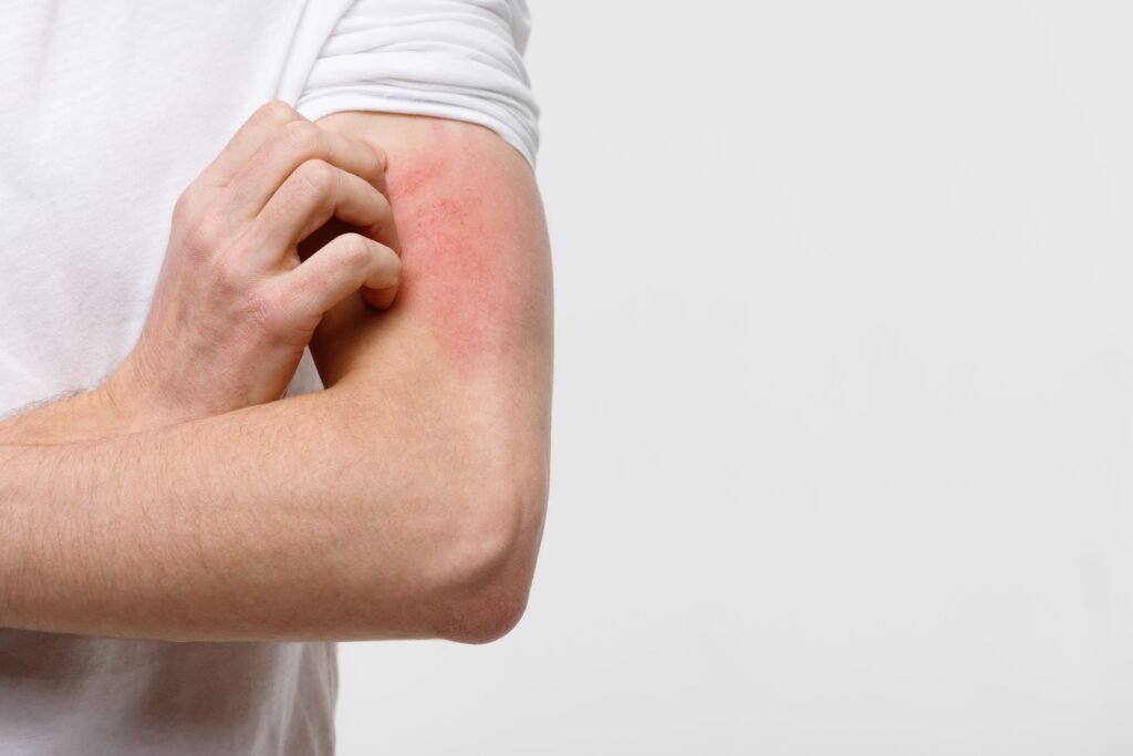 Essential insights into prurigo nodularis for dermatology professionals