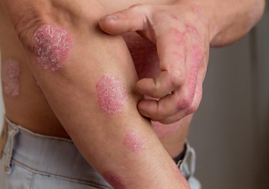 Exploring systemic treatments for psoriatic disease