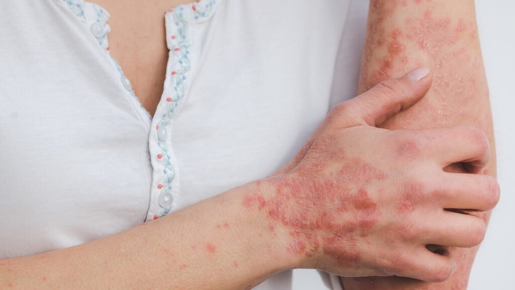 Rainy season woes: 4 ways monsoon triggers psoriasis flare ups