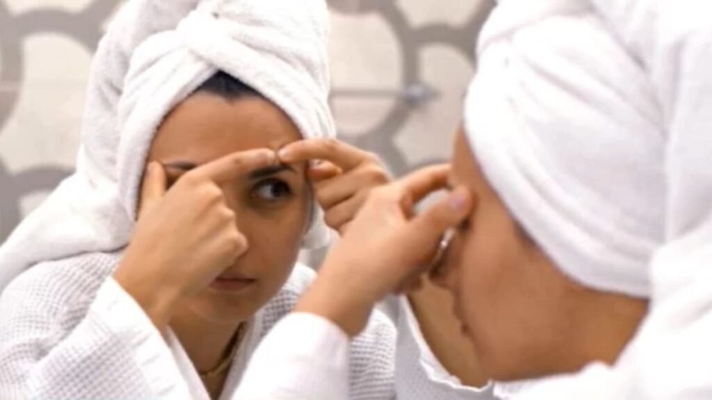 Smart solutions for teen acne: start simple and avoid popping