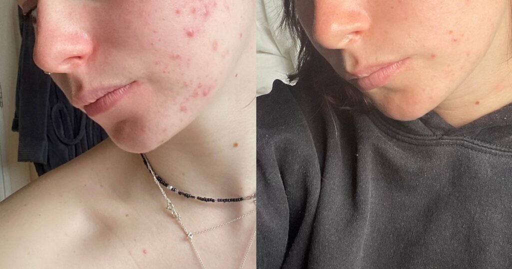 Transform your skin: essential skincare deals for teens before school