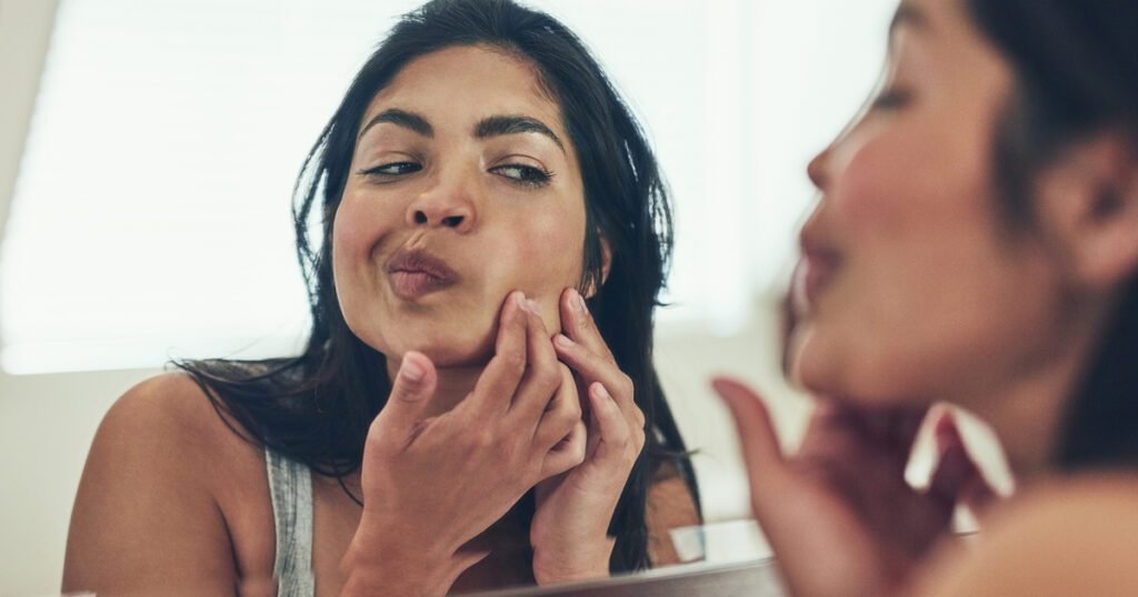 Unlocking the secrets of hormones and cystic acne