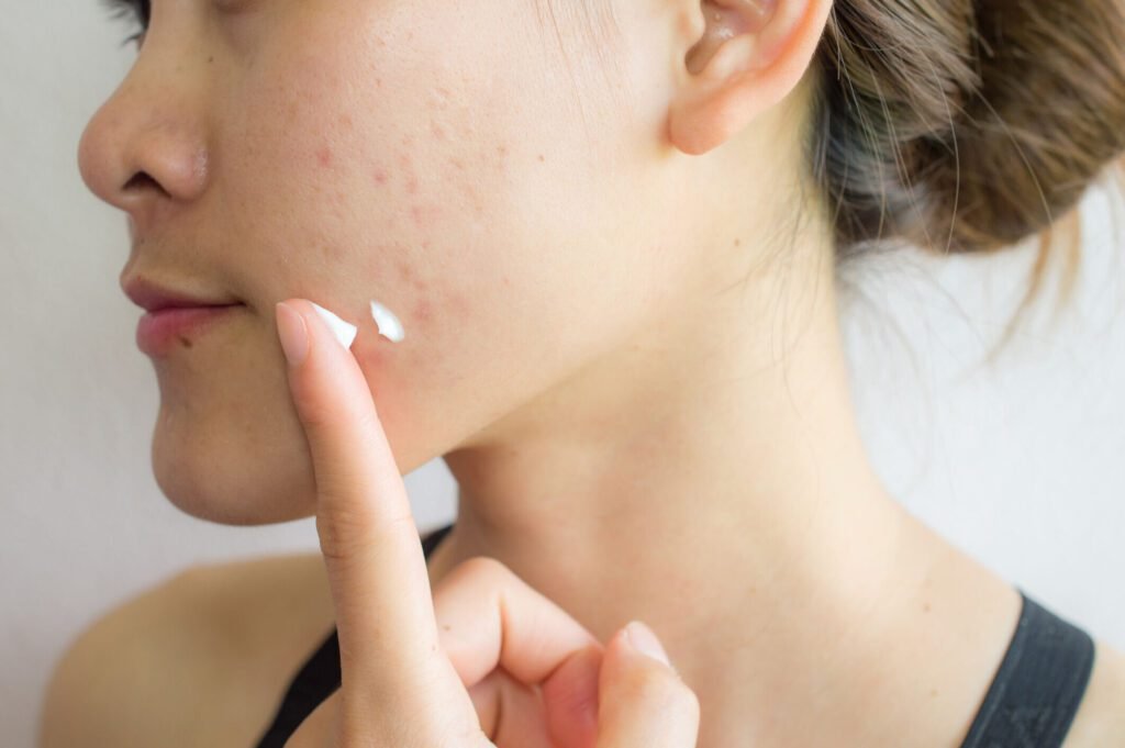 Stay calm and confident: addressing acne products contaminated with benzene