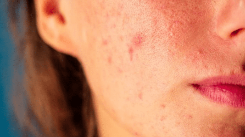Unlocking clear skin: understanding and overcoming adult acne